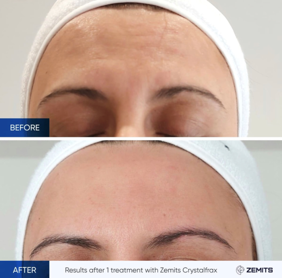 Fractional Radio Frequency Skin Tightening Treatment Avenir