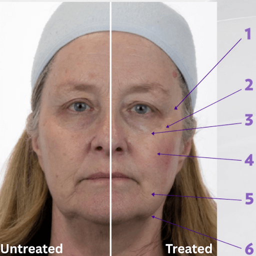 bedore-after-image-two-face-lift WOW