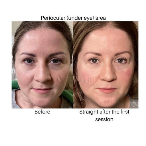 Biostimulator image five profhilo - before after