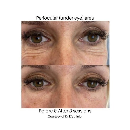 Biostimulator image four profhilo - before after