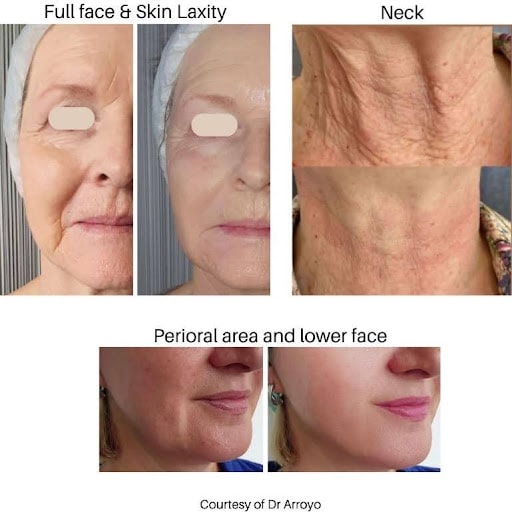 Biostimulator image one profhilo - before after