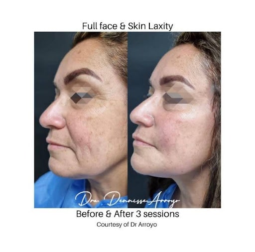 Biostimulator image three profhilo - before after