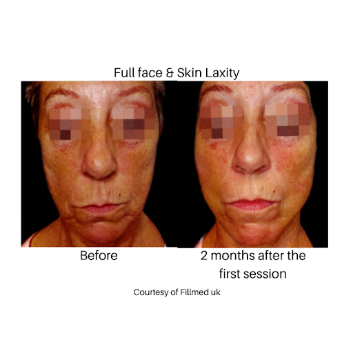 Biostimulator image two profhilo - before after